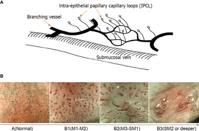 The current state of artificial intelligence in endoscopic diagnosis of early esophageal squamous cell carcinoma